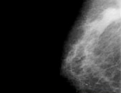ServicesHeader_mammography
